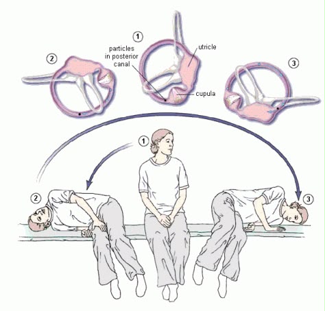 Repositioning maneuvers for BPPV
